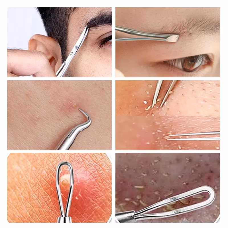 Wie bekomme ich geschlossene Mitesser weg?